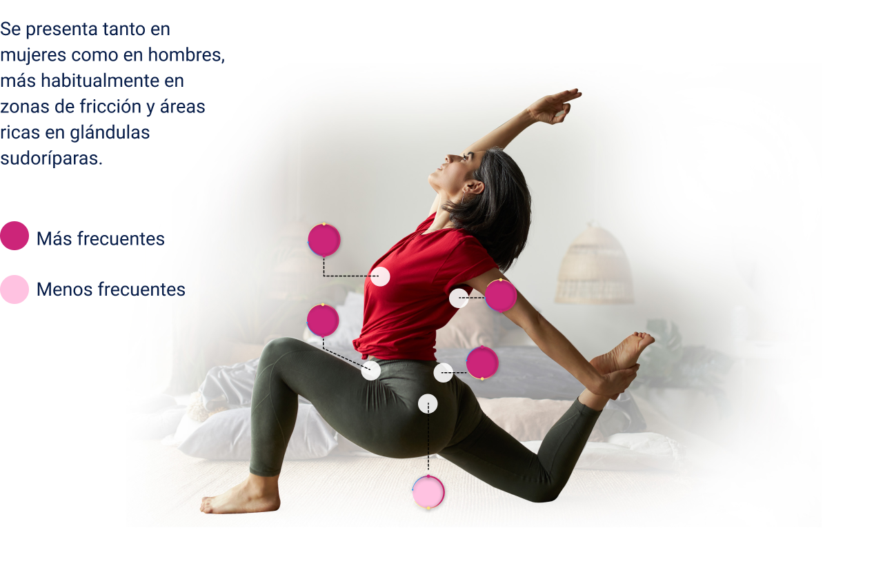 Imágenes creadas a partir de: Santagati A. La hidradenitis supurativa: una enfermedad tabú que sufren miles de argentinos. En: clarín.com, periódico digital, sección “Sociedad”. [Internet]. Bue- nos aires, Argentina: Arte Gráfico Editorial Argentino S.A.; 1996-2017 [Actualizado 13/10/2015; acceso el 12/08/2017].